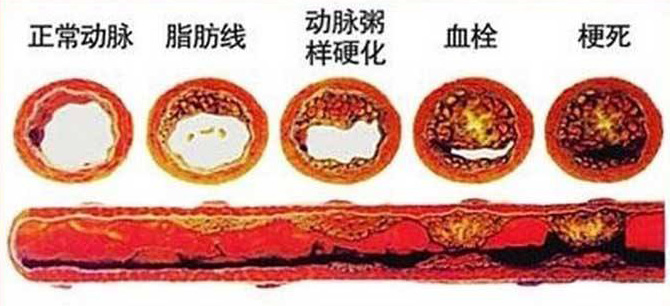 血栓在哪，病就在哪！該怎么清除血栓呢？