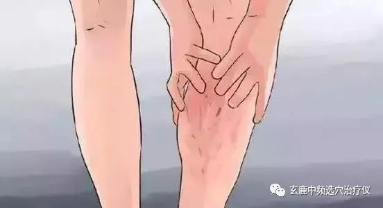 治療靜脈曲張，中醫(yī)有良方，一根針讓你告別“蚯蚓”腿