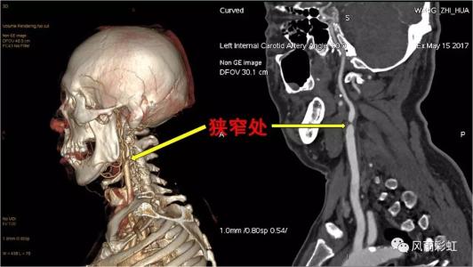 頸椎病都是“積”出來的，4個傷頸的行為，別總是做
